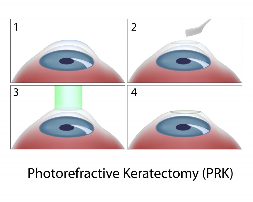 is-prk-safer-than-lasik-198263