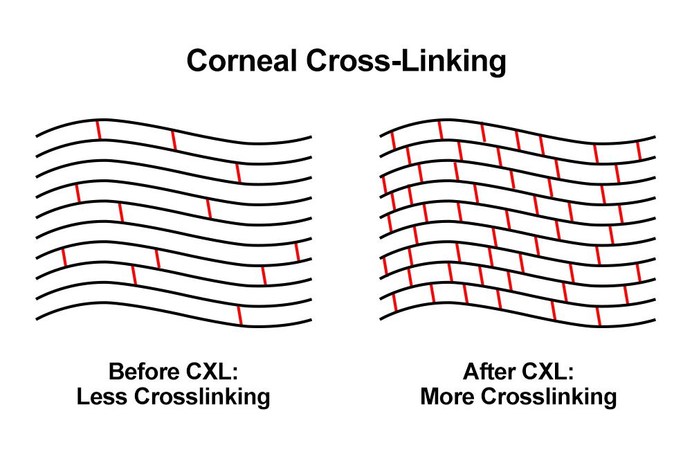 Corneal cross-linking tysons corner