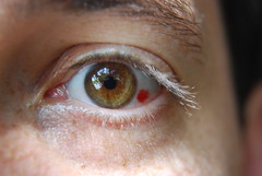 Red Spot on Eye