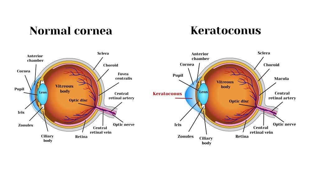 keratoconus-and-astigmatism-191135