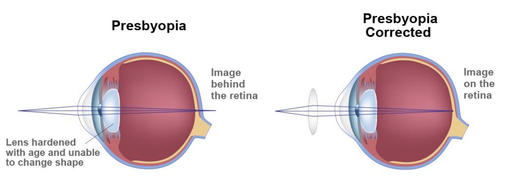 Presbyopia-3