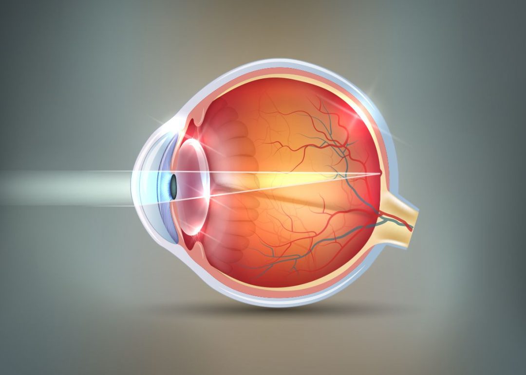 Corneal Cross-linking Strengthens The Cornea - Drholzman