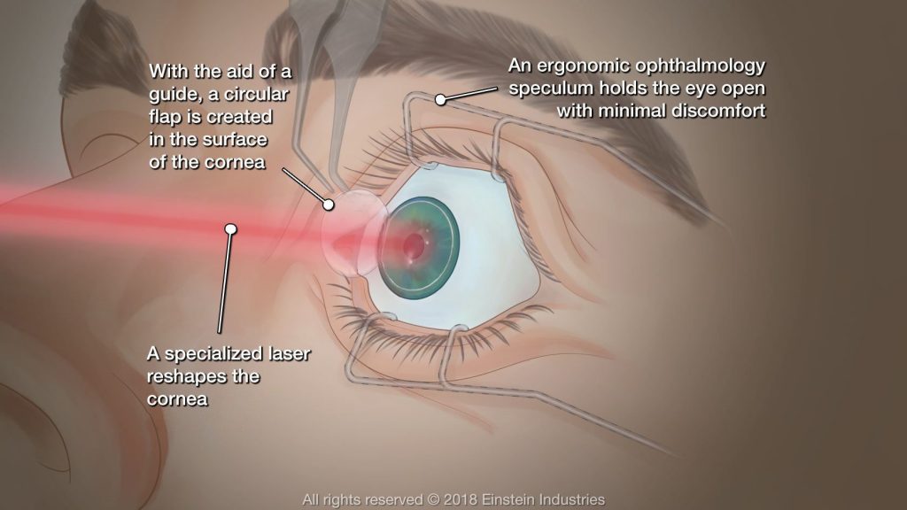 how-long-do-lasik-results-