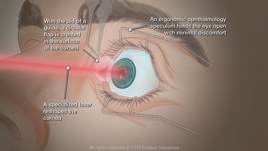 how-long-does-blurred-vision-normally-last-after-lasik-ke-eye