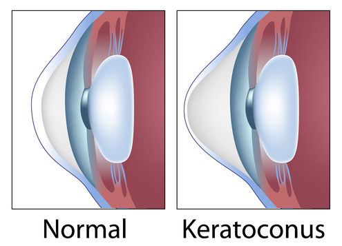 keratoconus-knowing-the-symptoms-can-166285